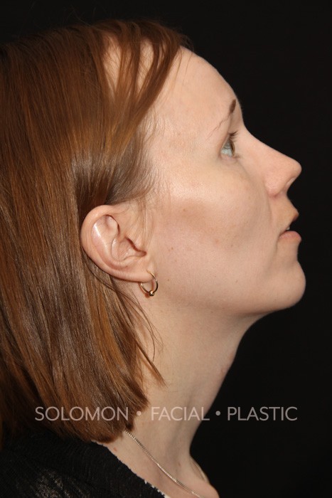 Patient 12 Solomon Facial Plastic