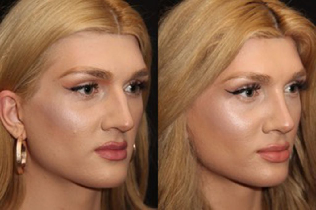 Facial Feminization Surgery In Toronto Solomon Facial Plastic