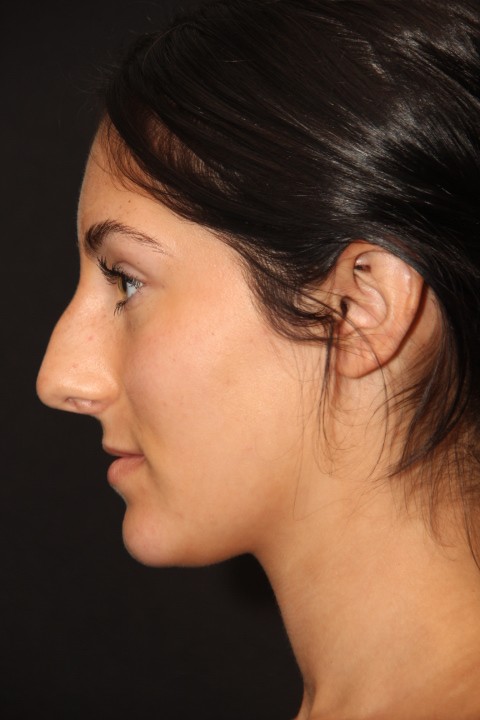 Closed Rhinoplasty For Dorsal Hump Before
