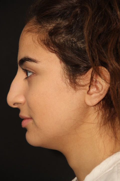 Rhinoplasty Surgery Patient Before