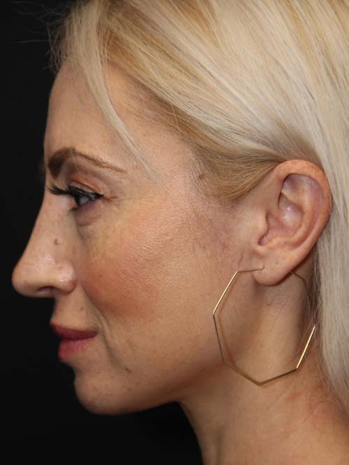 Intra-Nasal Rhinoplasty Surgery After