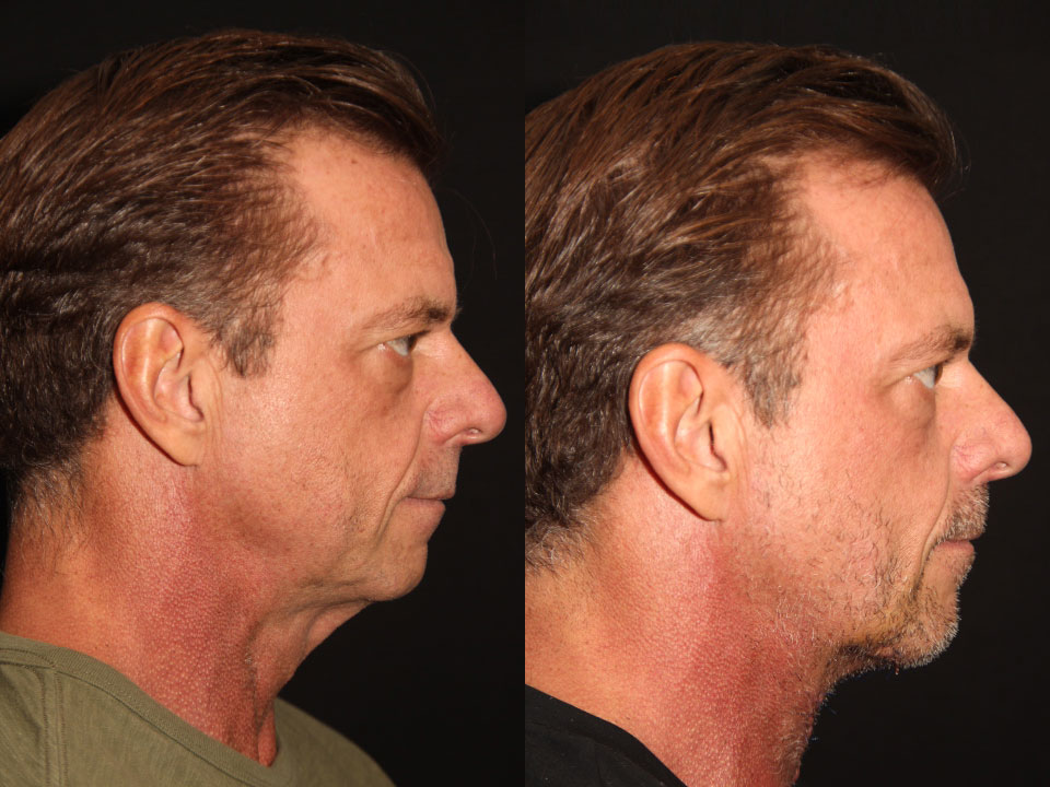 FACE LIFT AND NECK LIFT BEFORE AND AFTER TORONTO 3